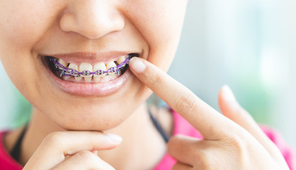 Women braces and is dirty, not beautiful.