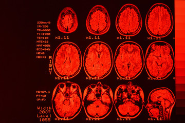 MRI scan or magnetic resonance image of head and brain scan. The result is an MRI of the brain with...