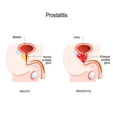 Femboy Prostate