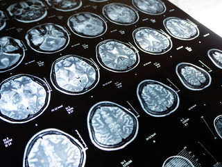 Film x ray brain tumor my mather ,Bangkok,Thailand