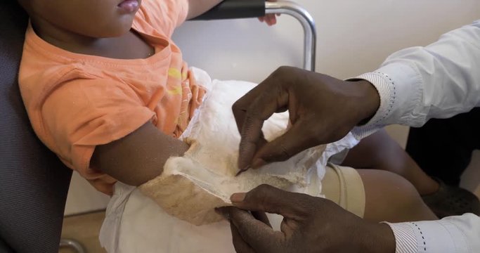 A top view of a cast being removed from a young African child who had a broken arm.