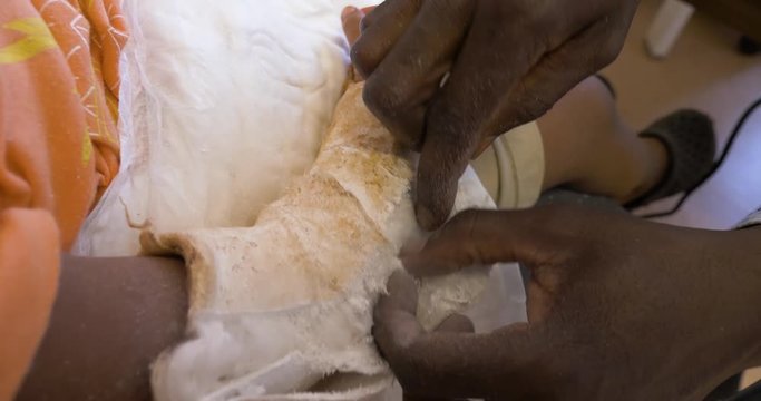 A close up view of a man using a razor blade to cut off a cast from the arm of a young child.