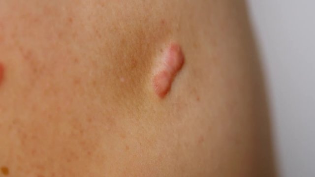 Keloid scar on person.