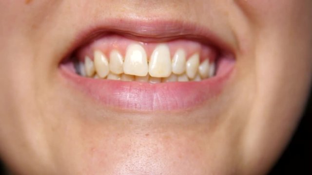 Person shows their teeth.