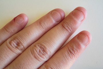 Fingers of a nail biter