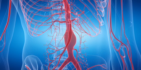 3d rendered medically accurate illustration of an aneurysm - obrazy, fototapety, plakaty