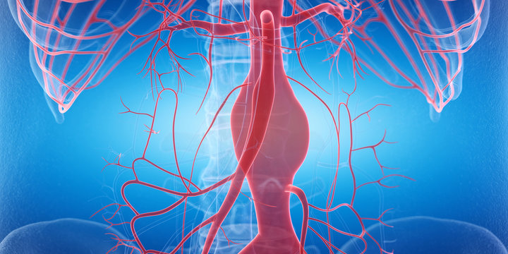 3d rendered medically accurate illustration of an aneurysm