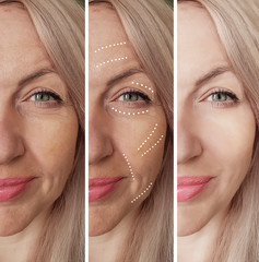 woman wrinkles face before and after correction procedures