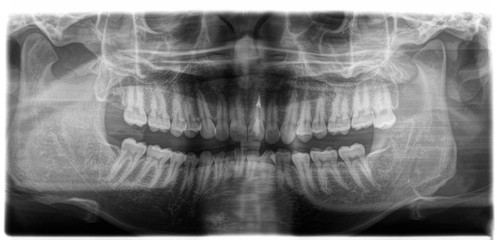 X ray of human mouth with teeth bones in black and white. Detail of panoramic facial x-ray image