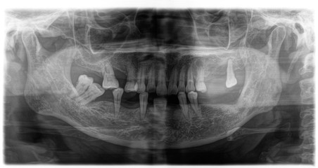 X ray of human mouth with teeth bones in black and white. Detail of panoramic facial x-ray image