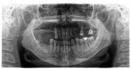 X ray of human mouth with teeth bones in black and white. Detail of panoramic facial x-ray image