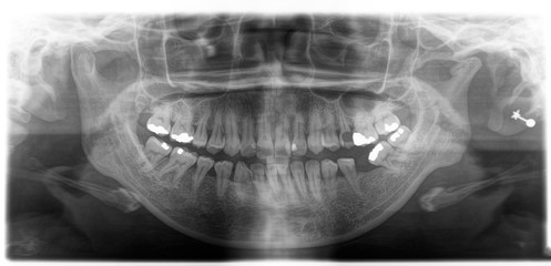 X ray of human mouth with teeth bones in black and white. Detail of panoramic facial x-ray image