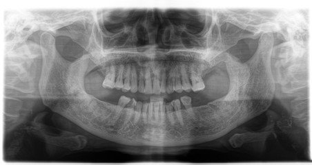 X ray of human mouth with teeth bones in black and white. Detail of panoramic facial x-ray image