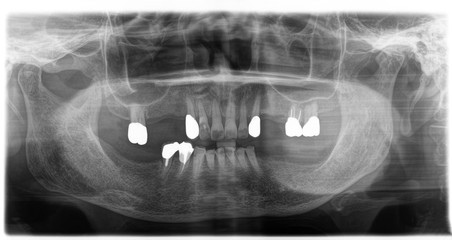 Fototapeta na wymiar X ray of human mouth with teeth bones in black and white. Detail of panoramic facial x-ray image