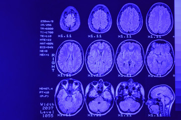 MRI scan or magnetic resonance image of head and brain scan. The result is an MRI of the brain with...