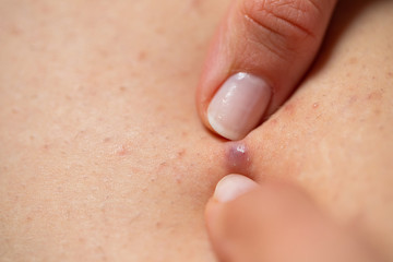 Folliculitis on female leg - squeezing