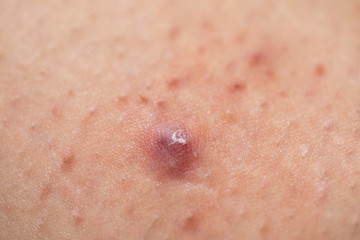 Painful folliculitis on female skin