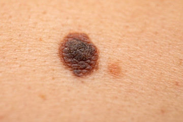 Dangerous nevus on skin - melanoma - obrazy, fototapety, plakaty