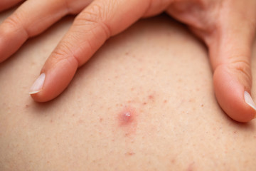 Folliculitis on female leg - squeezing