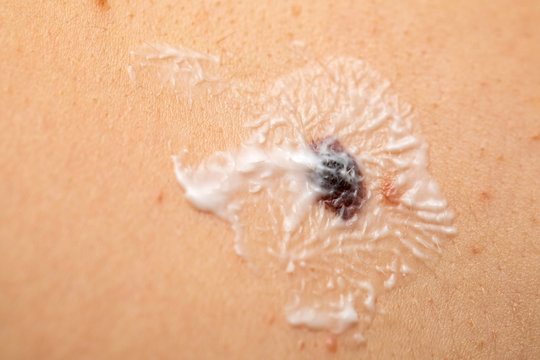 Sunscare lotion on naevus