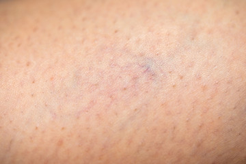 Spider veins on human leg