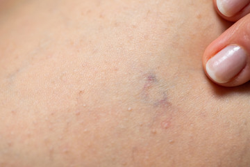 Fototapeta premium Varicose veins on leg - close up