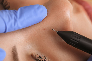Electrocoagulation of vessels on the face