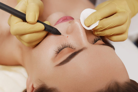 Electrocoagulation of vessels on the face