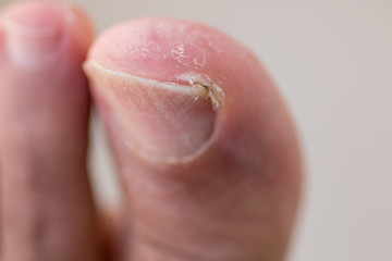 Big Toe with Ingrown Toenail, Scaly, Dry Skin and Cracking