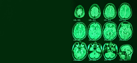 Banner. MRI of the brain of a healthy person on a black background with green  backlight. Left  ...