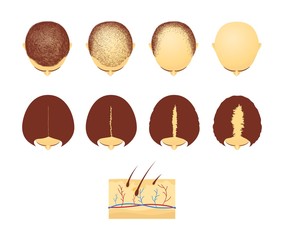 Set of male and female heads in top view with hair loss cartoon style