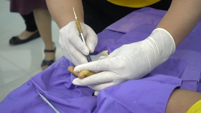 Trigger finger operation. Medical treatment , Digital flexer tenosynvitis, Stenosing tenosynvits