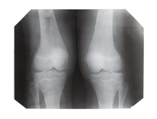film with X-ray image of front view of human knees