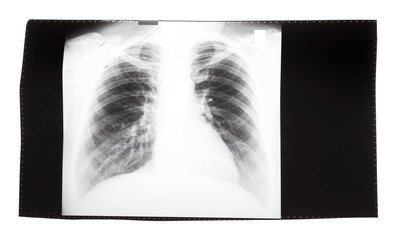 film with X-ray image of human thorax