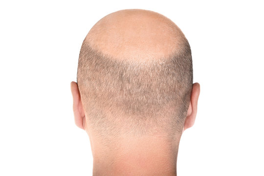 Concept of hair loss. Back view of balding male head isolated on white background. Detail showed alopecia