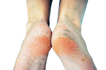 dehydrated skin on the heels of female feet