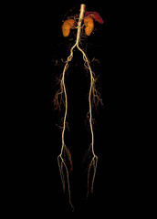 CTA femoral artery run off  3D rendering image of femoral artery with kidney  front viewfor diagnosis femoral artery disease.