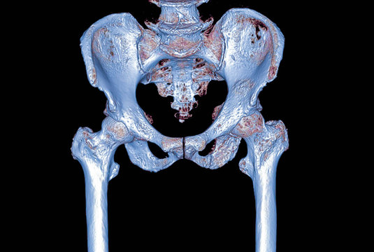 CT Scan of pelvic bone with both hip joint 3D rendering image for diagmosis fracture of hip joint.