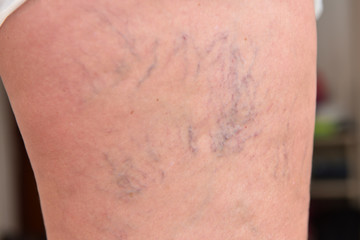 Fototapeta premium Varicose veins on female legs in the hips. Sipder veins thigh, close-up
