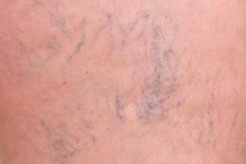 Fototapeta premium Varicose veins on female legs in the hips. Sipder veins thigh, close-up