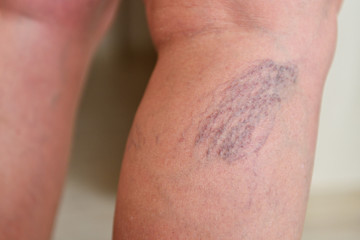 Fototapeta premium Varicose veins on female legs in the area of the knee and calves. Sipder veins thigh, close-up