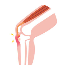 Osgood-schlatter disease (knee joint disease) illustration (no text)