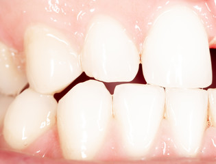 Curved teeth in a man's mouth.