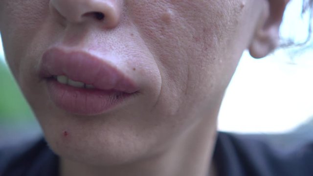Allergic reaction to insect sting. A woman who are stung by a bee. Edema, swelling lips