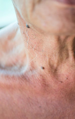 Warts on the skin of the elderly