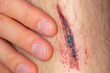 Deep gash on the leg of a young male person