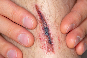Fototapeta premium Deep gash on the leg of a young male person