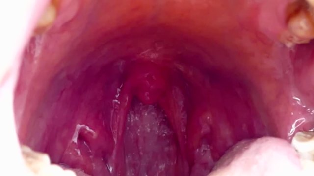 tonsils deformed, tonsillitis, neglected poor human mouth interior,