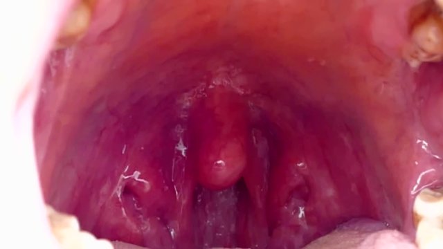 Intraoral tonsil in the mouth, tonsillitis, neglected human mouth,