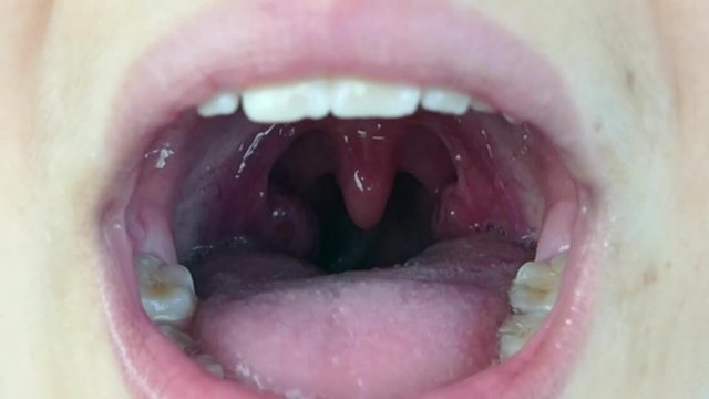 a child's tonsils mouth inside and tonsillitis...